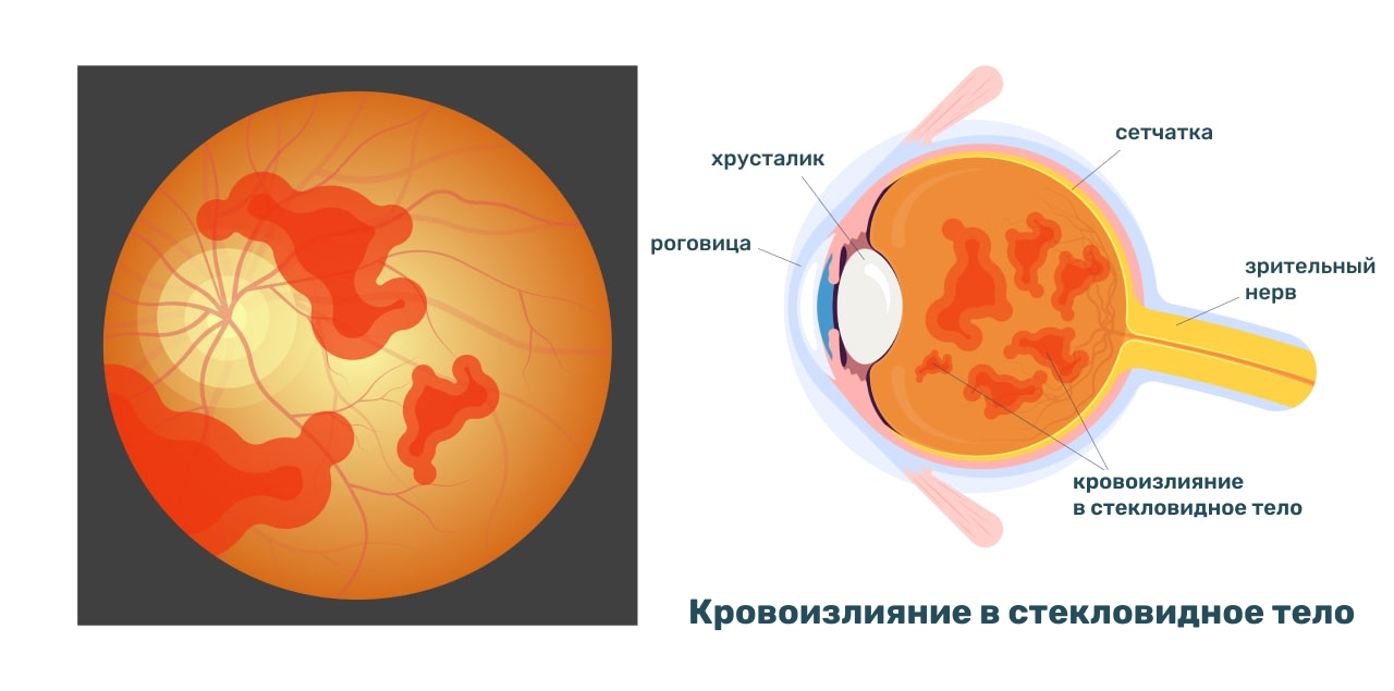 Гемофтальм - кровоизлияние в стекловидное тело