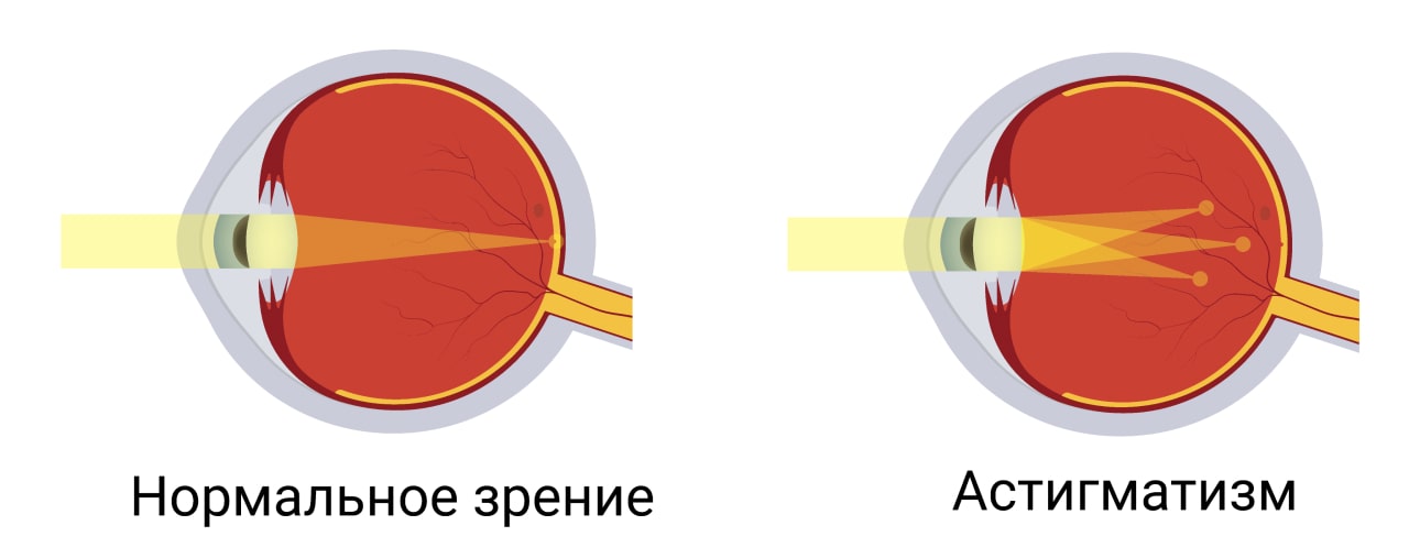 Астигматизм