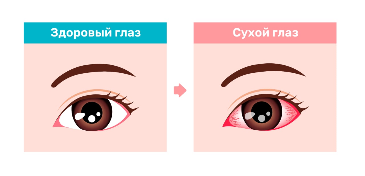 Синдром сухого глаза