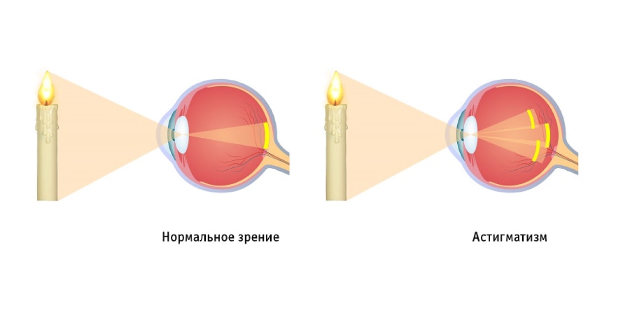 Астигматизм