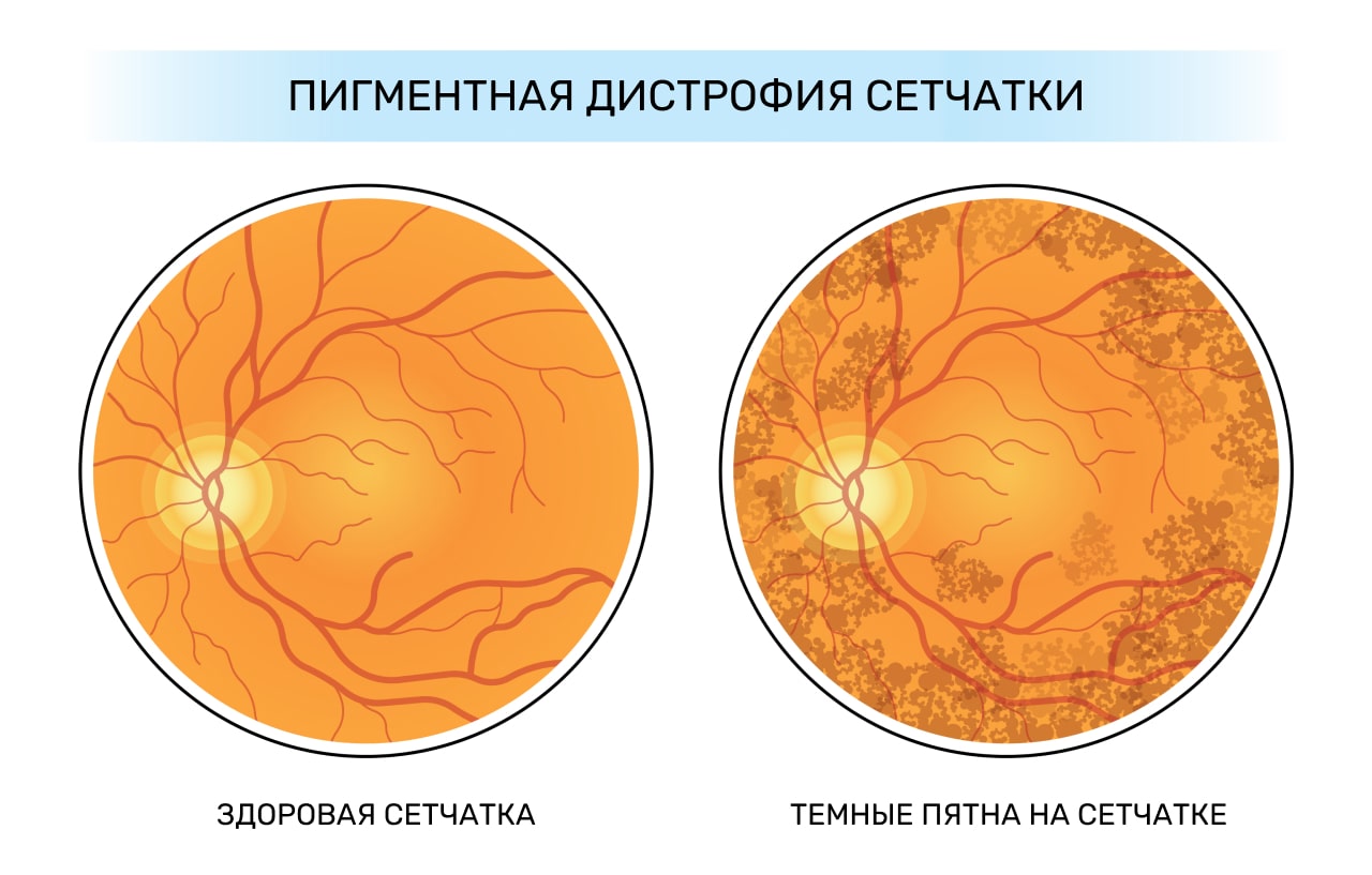 Пигментная дистрофия сетчатки