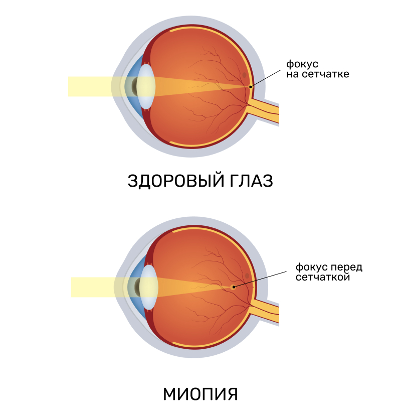Миопия (близорукость)