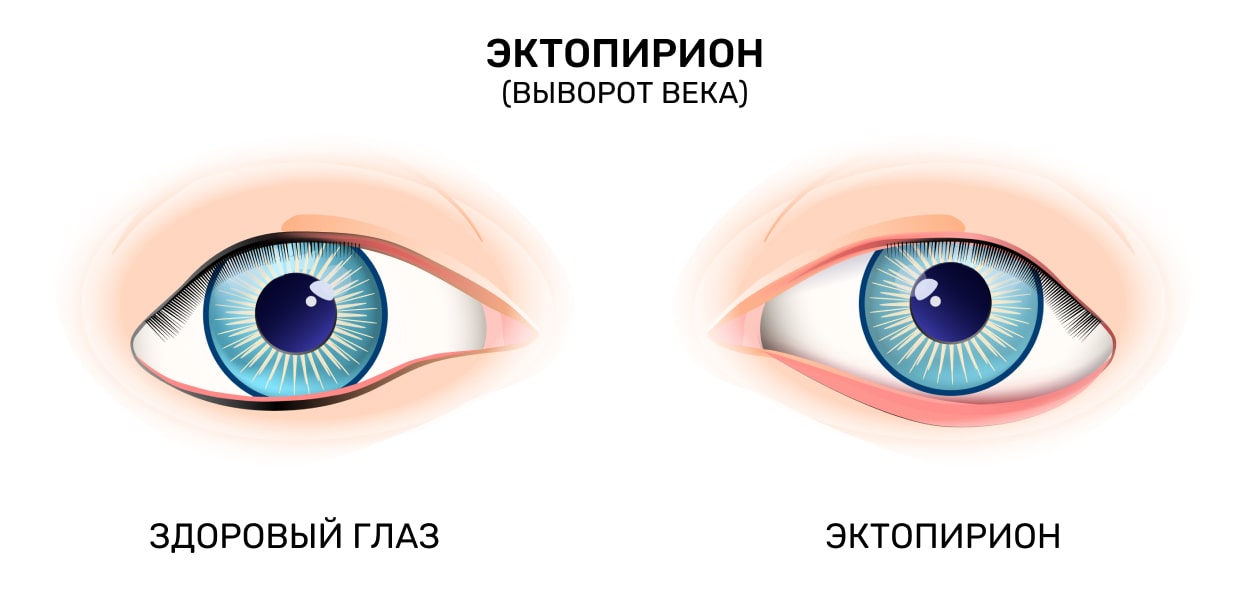 Эктопирион (выворот века)