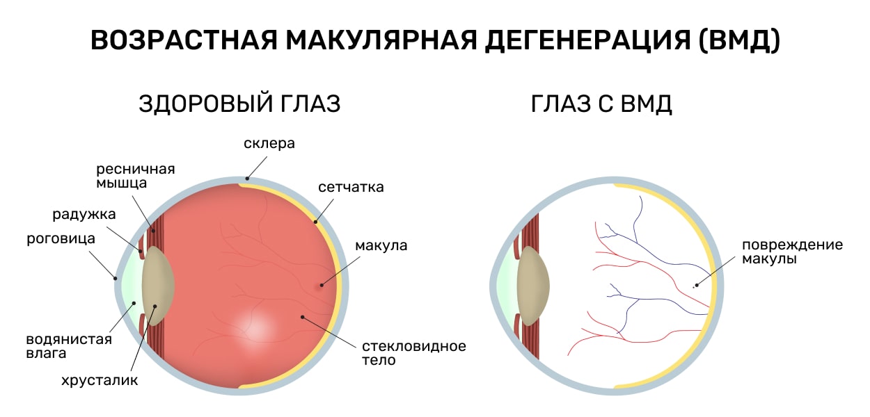 Возрастная макулярная дегенерация