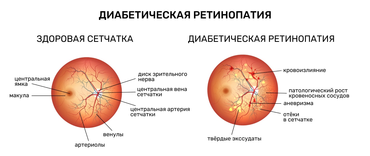 Диабетическая ретинопатия