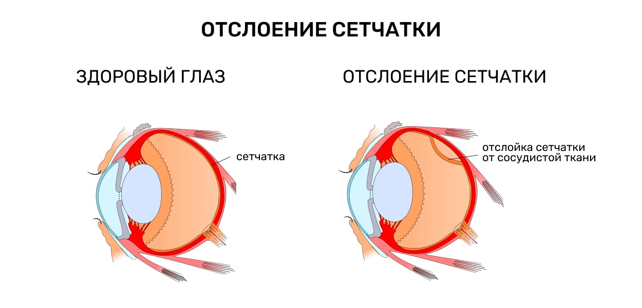 Отслойка сетчатки