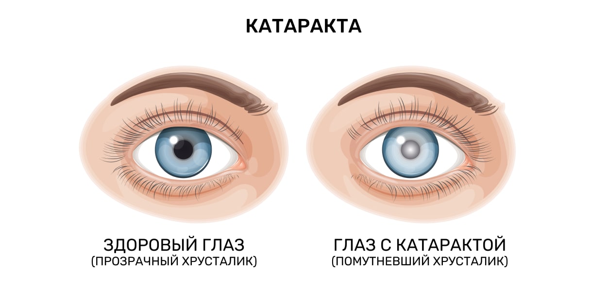 Катаракта