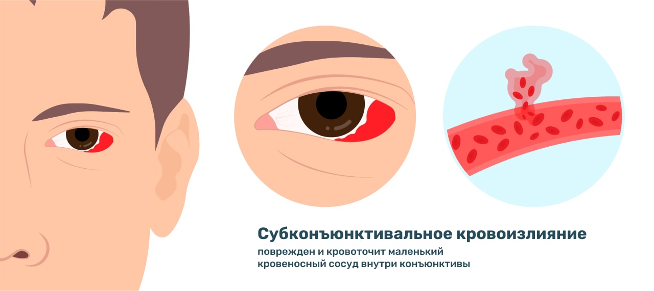 Субконъюнктивальное кровоизлияние