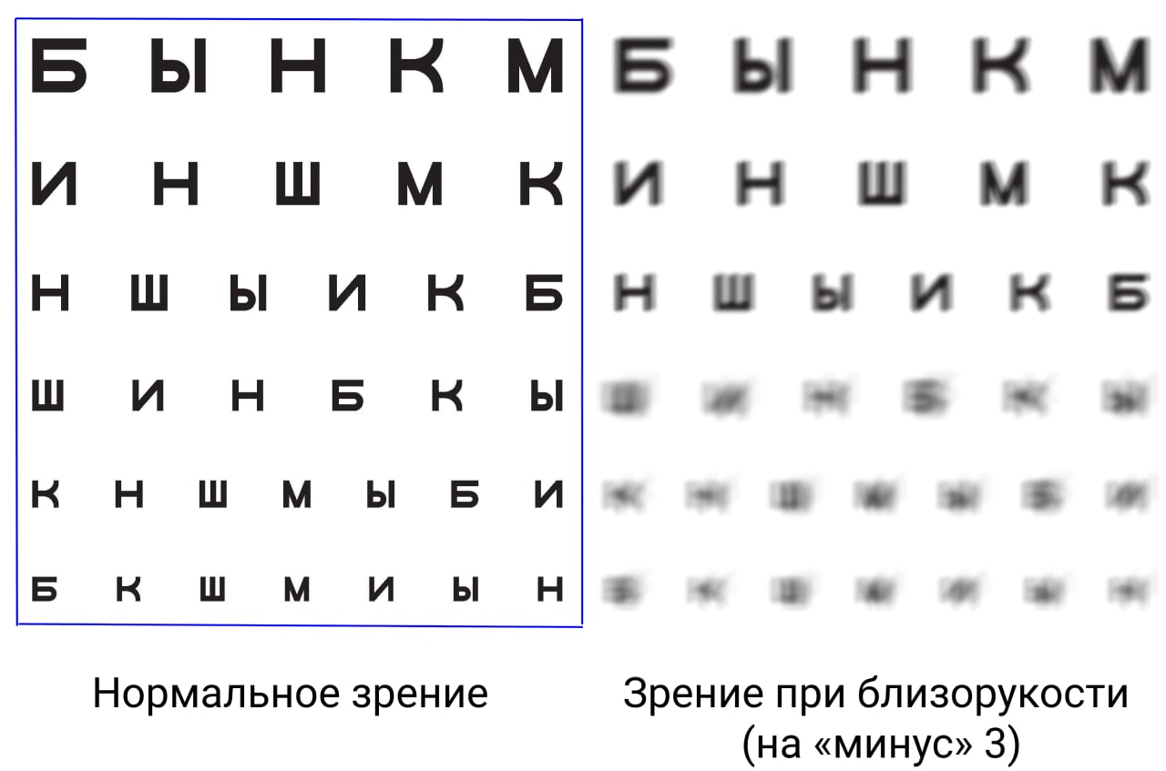 Зрение при близорукости на «минус» 3