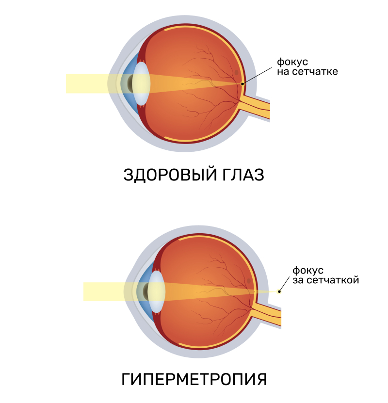 Гиперметропия (дальнозоркость)