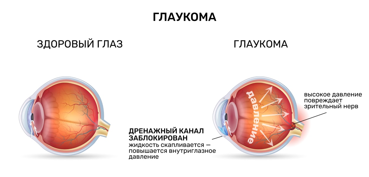 Глаукома