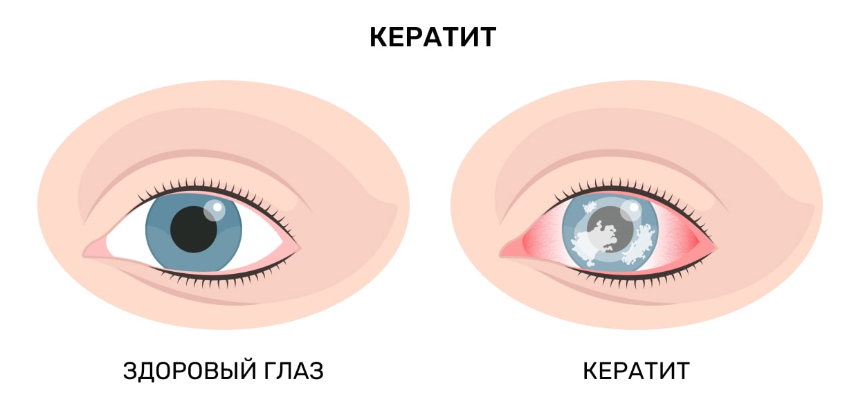 Кератит (воспаление роговицы)