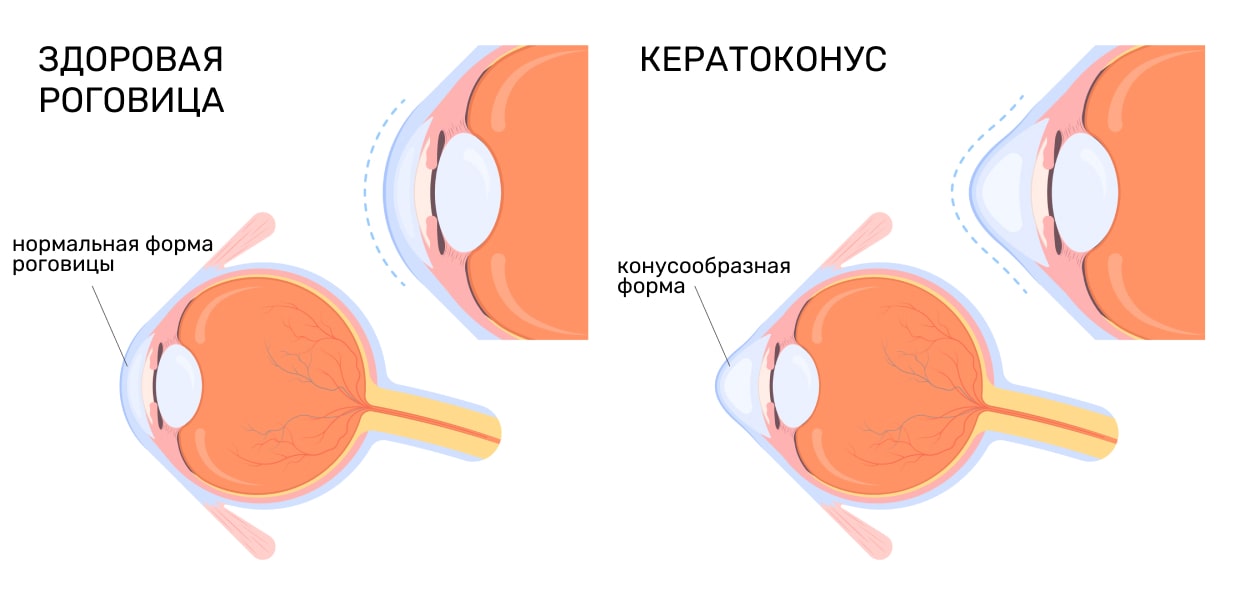 Кератоконус (истончение роговицы)