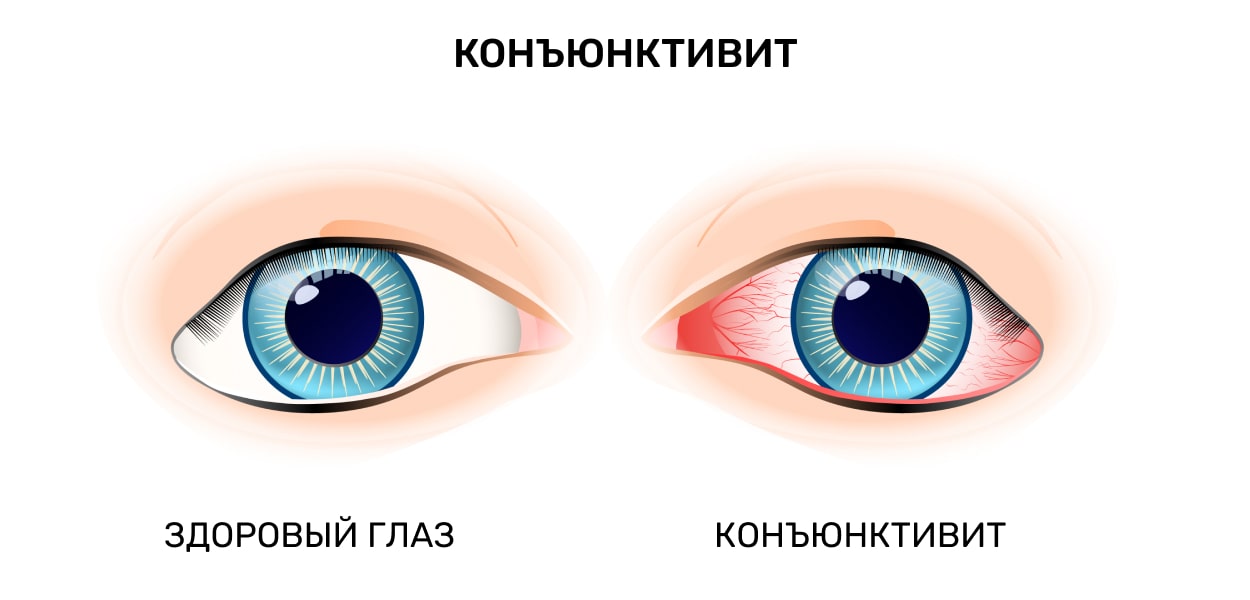 Конъюнктивит