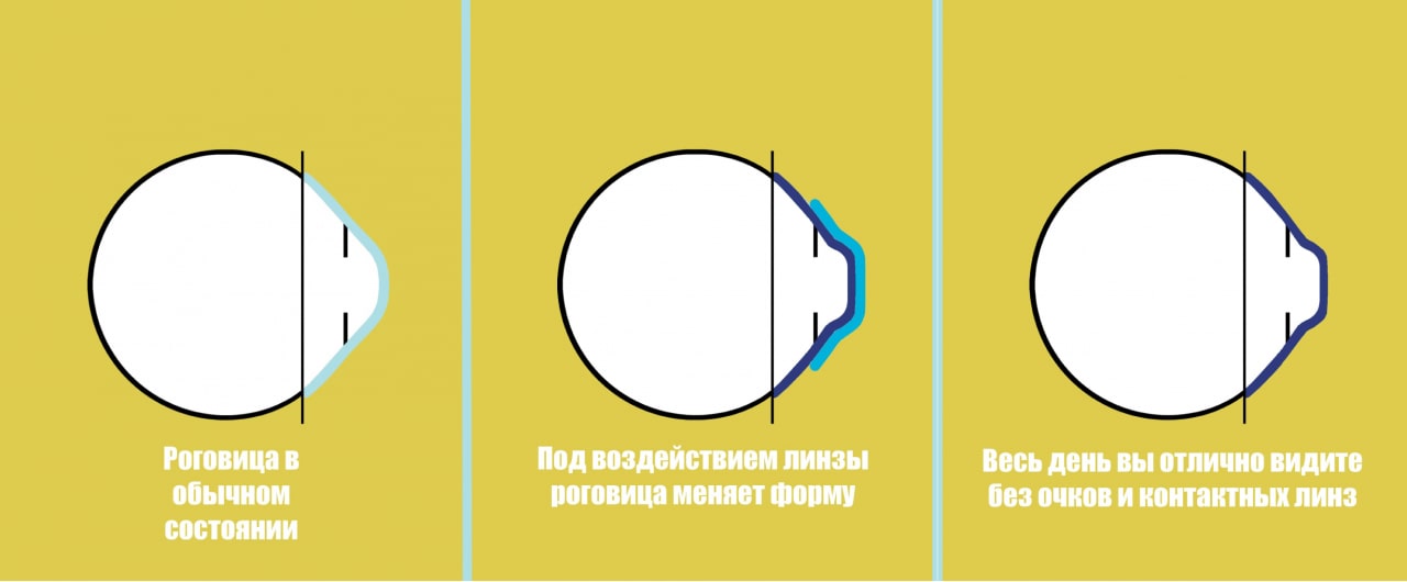 Ортокератологические линзы