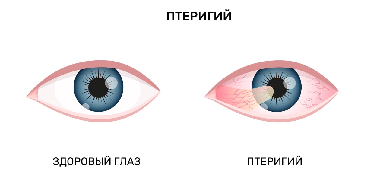 Птеригий (птеригиум)