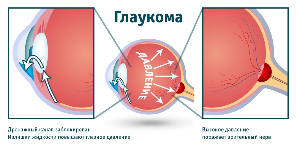 глаукома что это