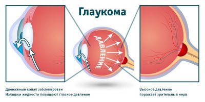 Глаукома
