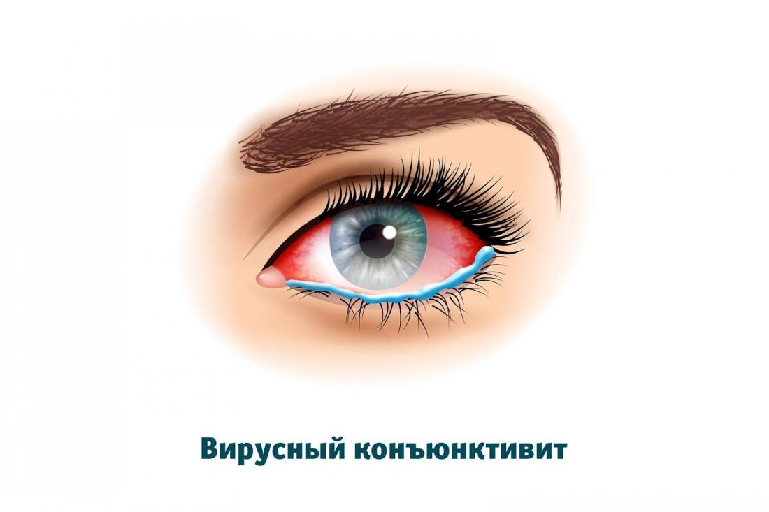 Вирусный конъюнктивит