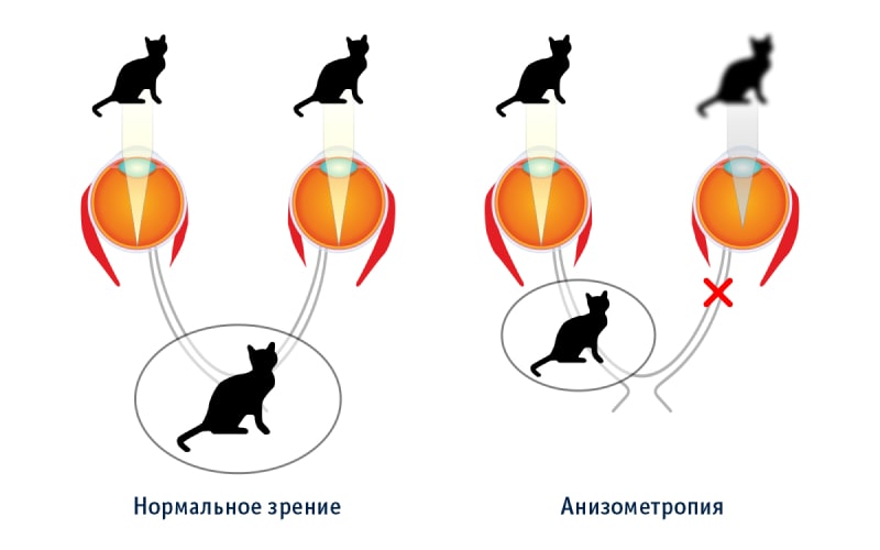 Анизометропия - разная рефракция в каждом глазу