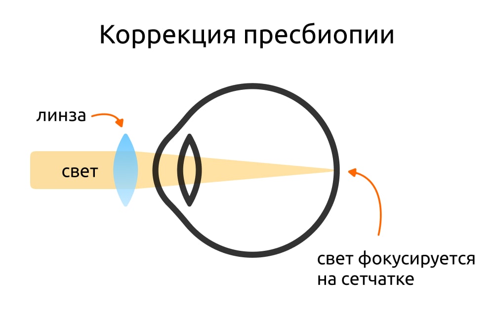 коррекция пресбиопии
