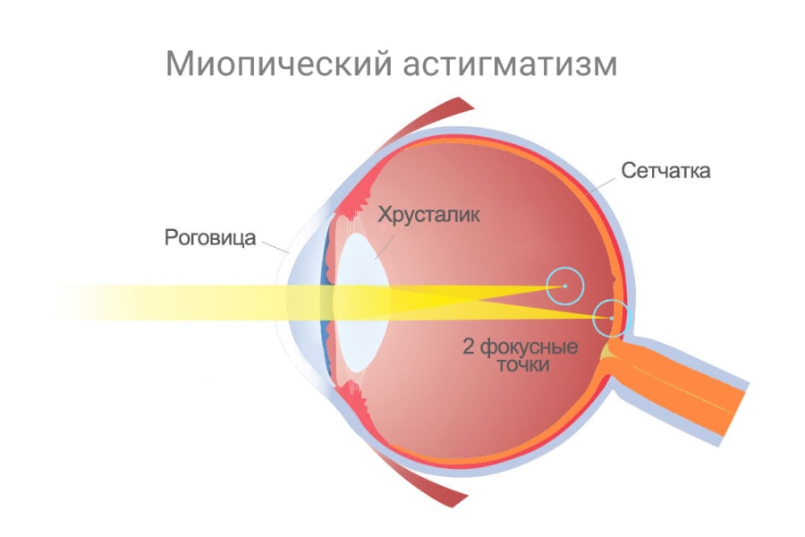 Миопический астигматизм