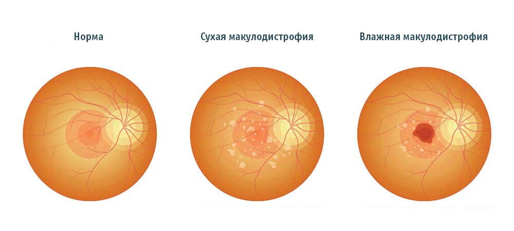 Сухая макулодистрофия, влажная вмд, норма