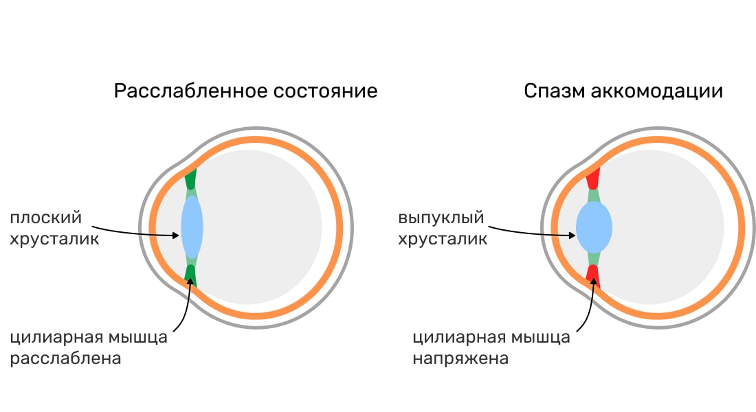 Спазм аккомодации