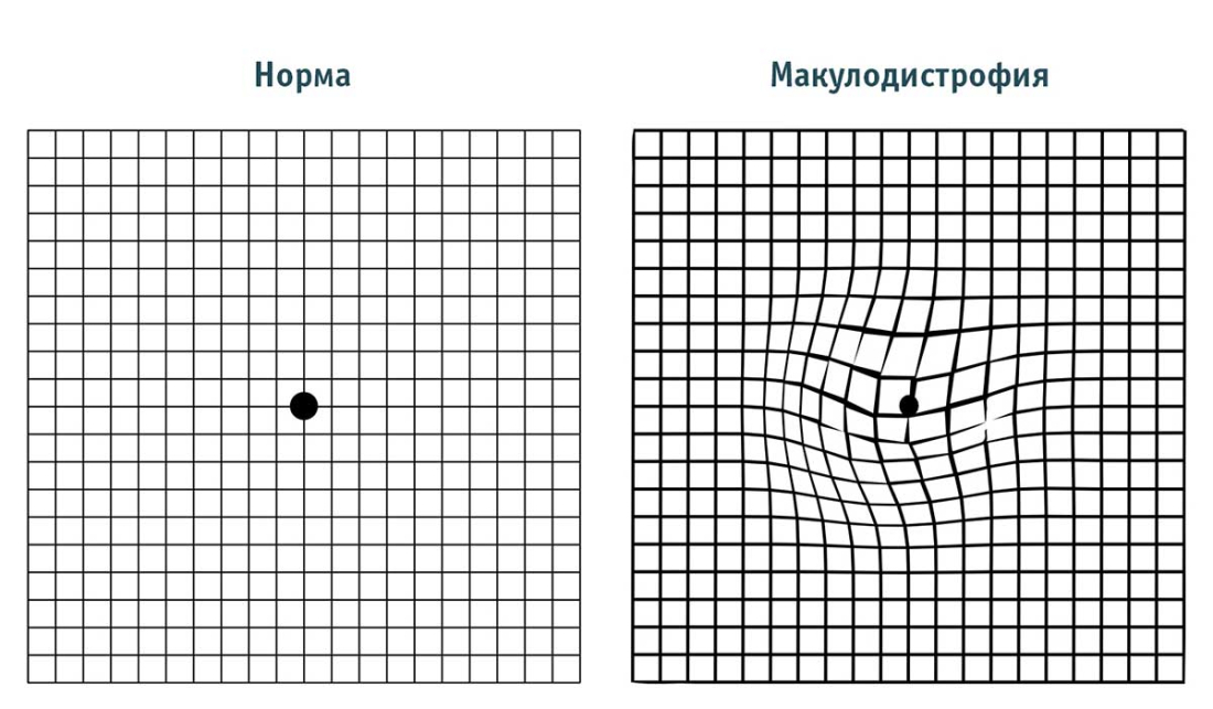 Тест Амслера