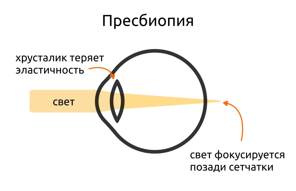 пресбиопия