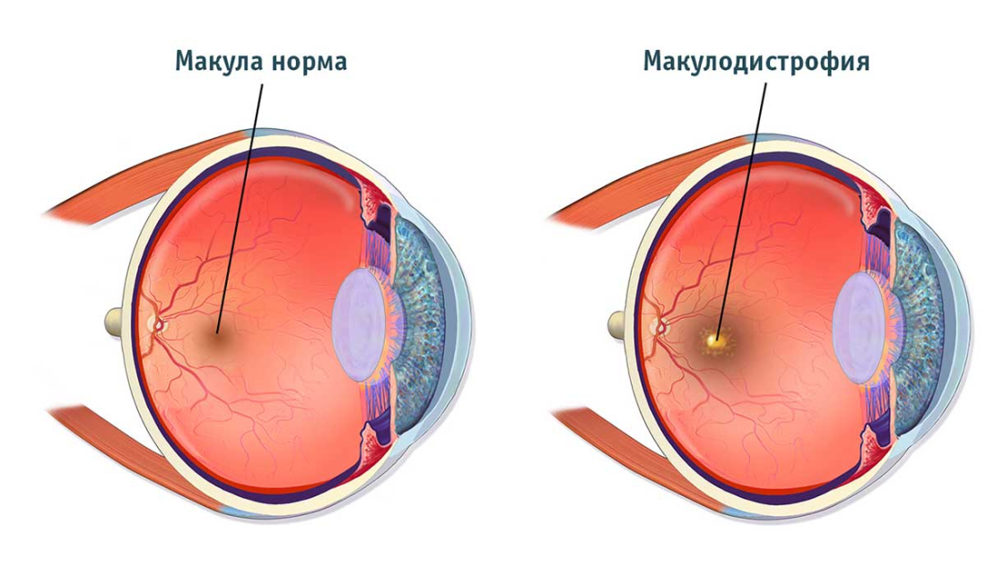 Макулодистрофия