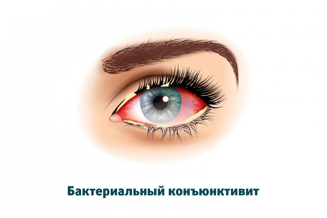 Бактериальный конъюнктивит