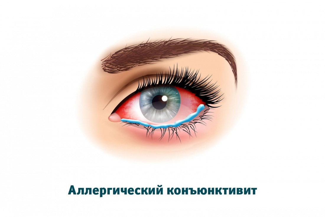 Аллергический конъюнктивит