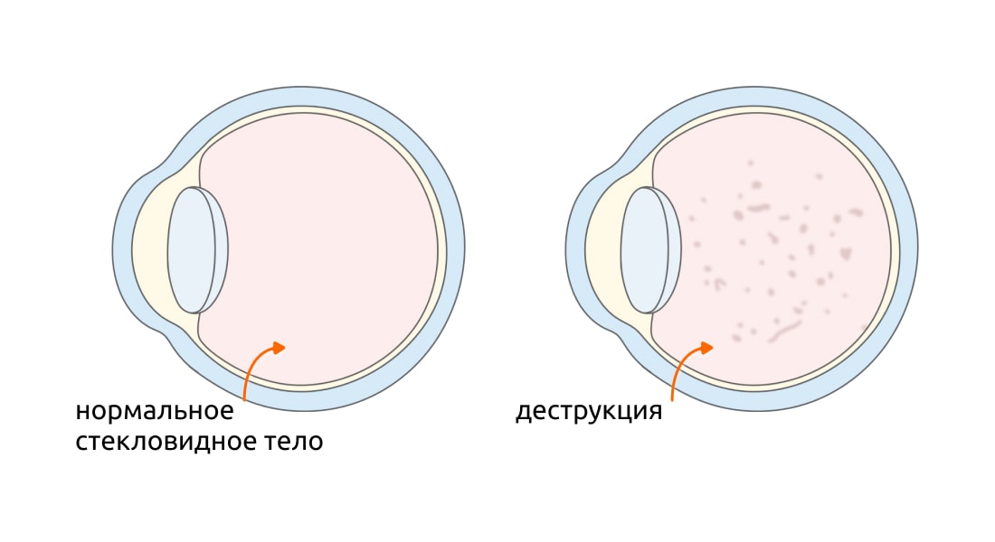 Деструкция стекловидного тела глаза